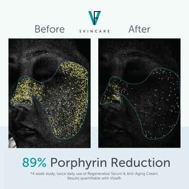 FACTORFIVE Regenerative Serum porphyrin reduction results