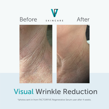 FACTORFIVE Regenerative Serum winkle reduction results
